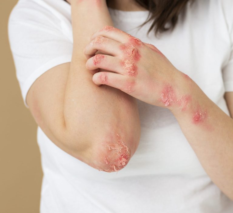 hands-patient-suffering-from-psoriasis (1)